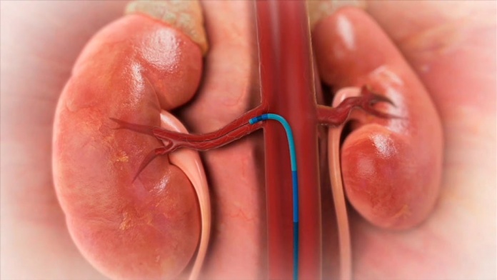 ¿Qué es la Denervación Renal? La solución para los pacientes resistentes a la hipertensión arterial