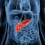 Club de Páncreas advierte sobre los riesgos de la pancreatitis y los cálculos de vesícula